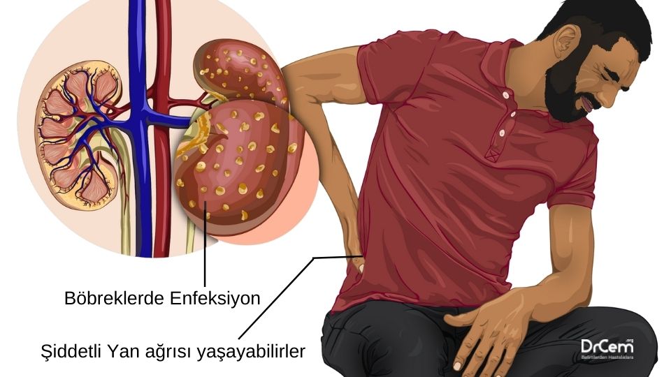 Pyelonefrit görseli - DrCem hastalık rehberi